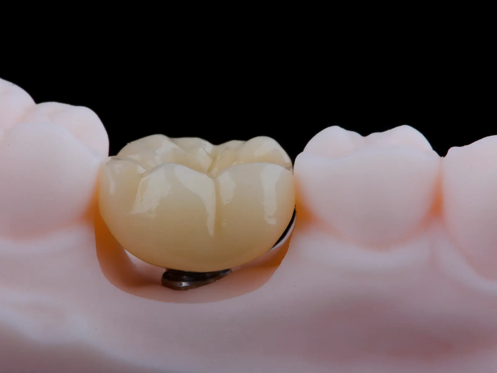 A single ceramic crown seated on a model, showing the emergence profile at the gum line