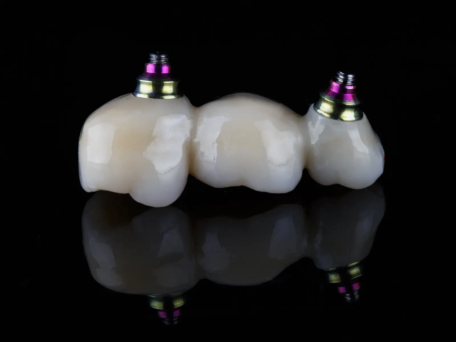 Three-unit zirconia bridge